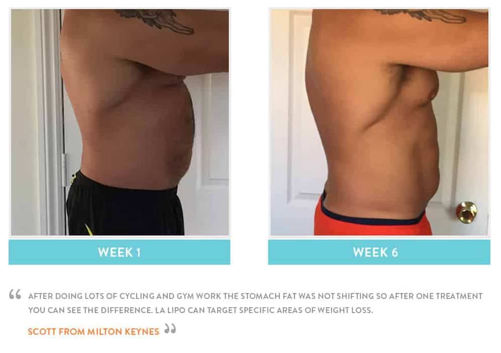 Before & After Stomach Fat Wickford