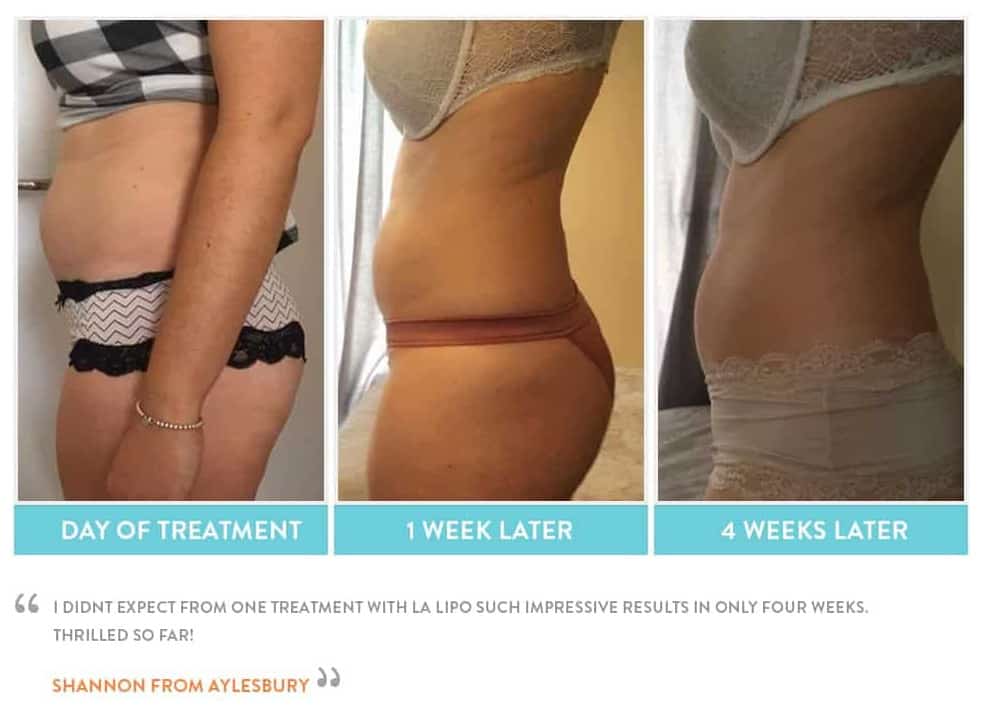before, Cryolipolysis Wickford