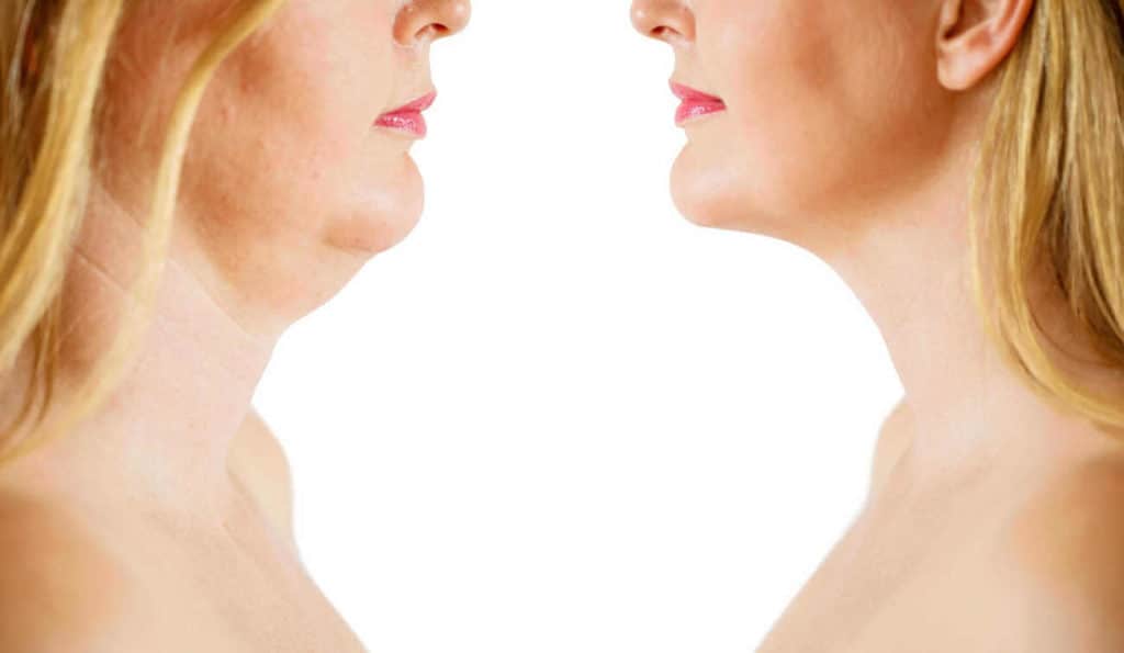 Double Chin treatment Wickford before and after results