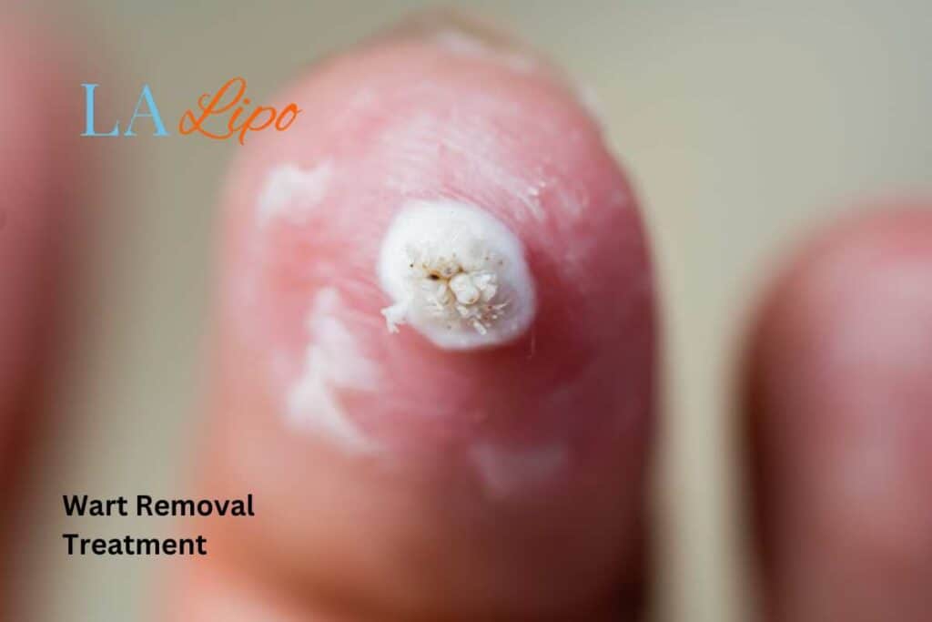 wart removal
