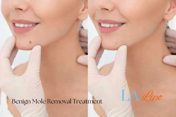 woman's before and after mole removal Wickford results