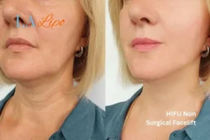 hi-fu for wrinkles Wickford before and after results