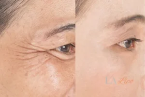 Before and after results of woman - HI-fu wrinkles reduction treatment Wickford