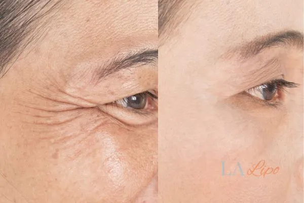 Before and after results of woman - HI-fu wrinkles reduction treatment Wickford