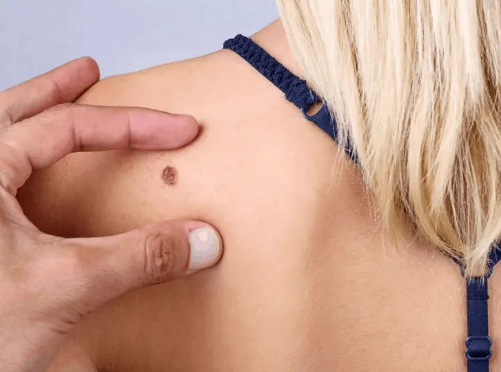 woman having mole removal Wickford consultation before treatment.