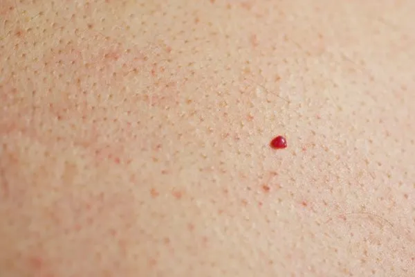 close up of a cherry angioma Wickford