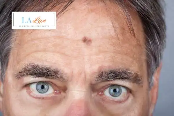 Solar Lentigo Removal Wickford image of man with mark on his forehead