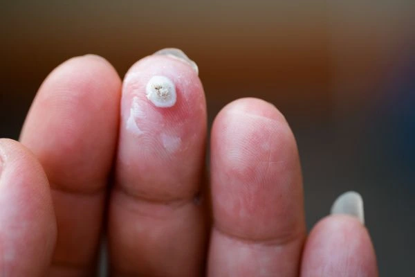 wart on person finger - cryotherapy to treat from LA LIPO Wickford