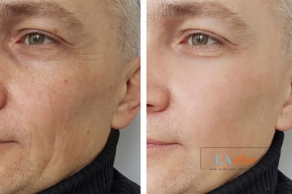 See the amazing results of Morpheus8 Treatment Wickford!