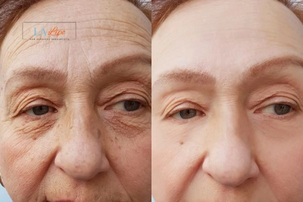 The powerful benefits of Morpheus8 Treatment Wickford - Call Our team today!