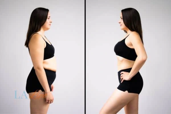 Picture of womans before and after using LA-EMS body sculpting to improve her core strength Wickford