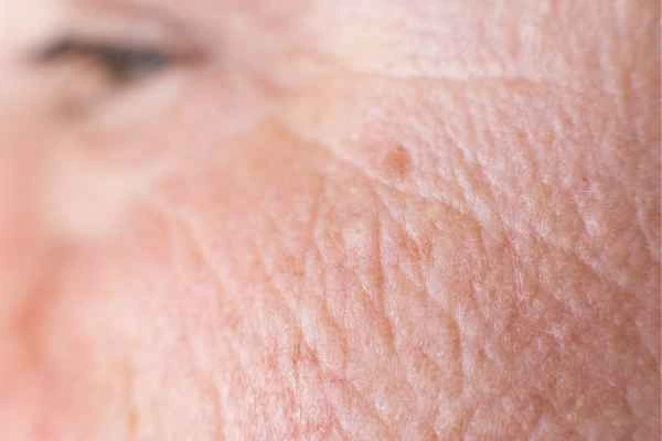 close up picture of a woman's face showing an age spot Wickford