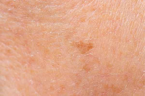 close up picture of age spots Wickford