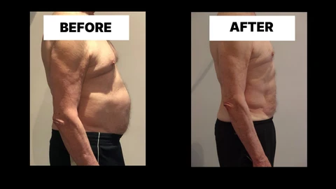 What Symptoms Can Diastasis Recti Cause in Men? Weak Core, Back Pain and Poor Posture Wickford